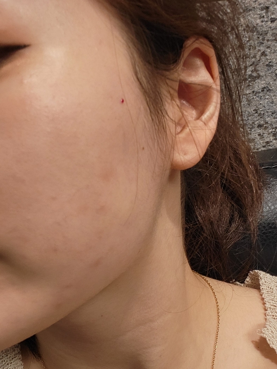 bbl 레이저 후기