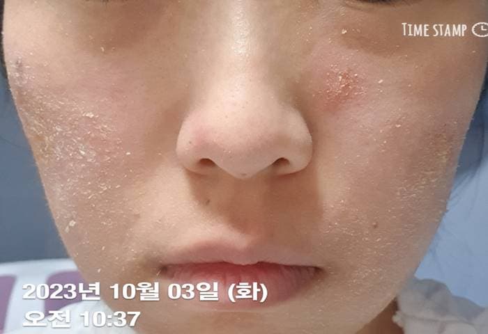 얼굴 피부염
