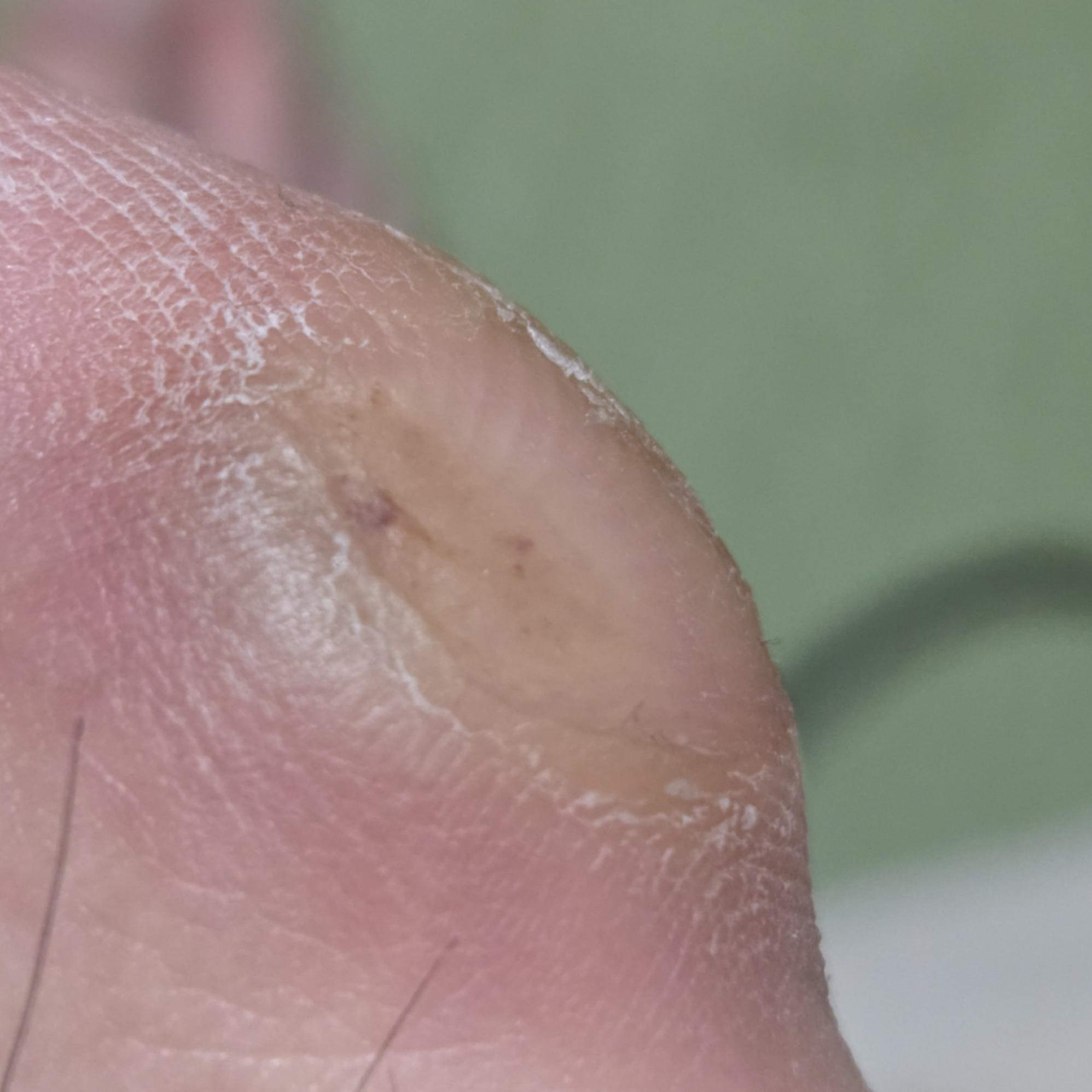 엄지에 굳은 살