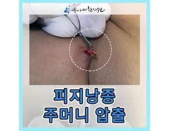 엉덩이 종기가 생기는 이유 왜 생기고 어떻게 관리할까요 완벽 가이드_25