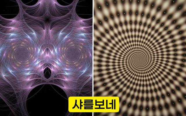 실명 전조증상 샤를 보네 증후군