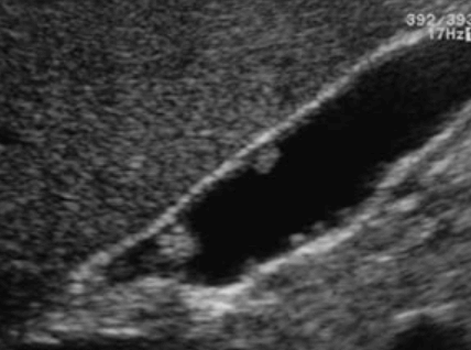 콜레스테롤 용종 (cholesterol polyp)