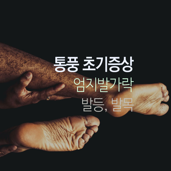 통풍-초기증상