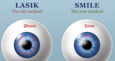 라섹과 스마일라식 차이에 대한 사진