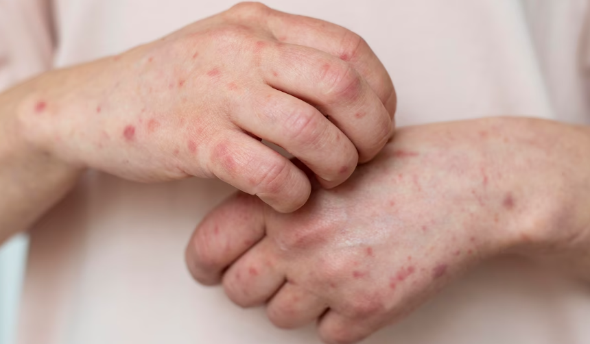 아나팔락시스의 증상