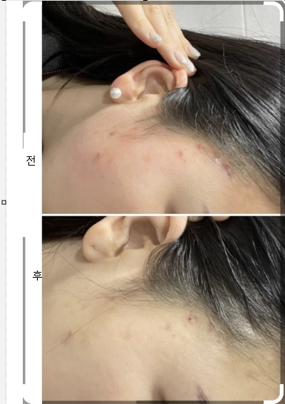 연고 사용 전후 사진