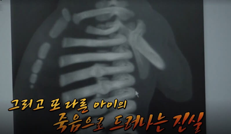 갈비뼈가 부러진 아이의 ct 화면