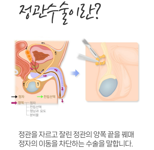 정관수술