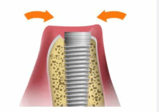 평택-임플란트-잘하는-치과-평택-임플란트-유명한-곳-평택-임플란트-가격