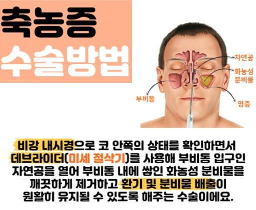 축농증의 치료법
