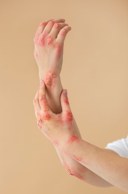 대상포진-피부2