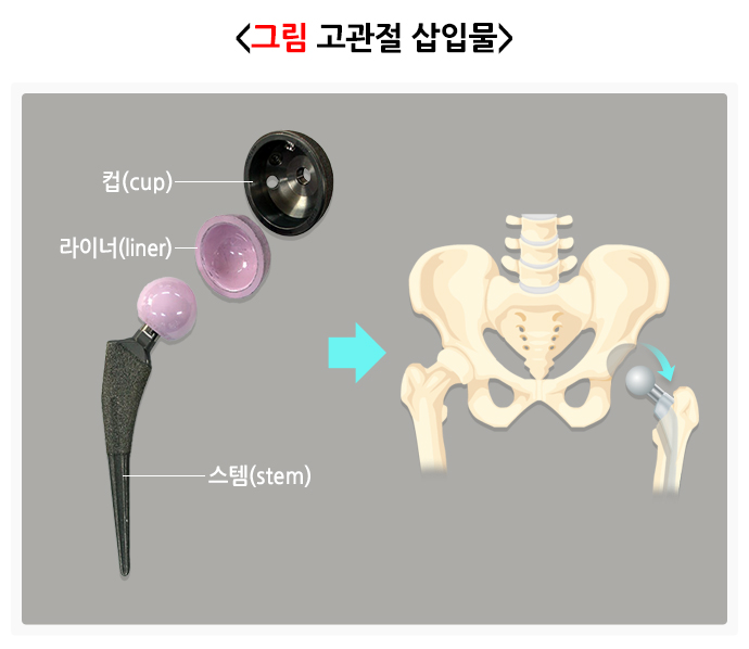 고관절인공관절, 고관절전치환술, 인공관절수술, 티타늄인공관절, 로봇인공관절수술