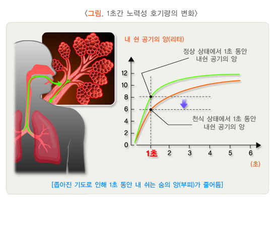 천식 치료