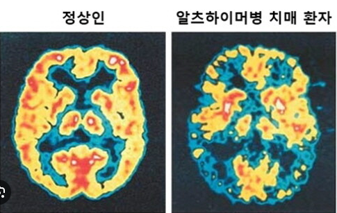 정상인의 뇌 vs. 알츠하이머병 환자의 뇌