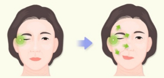 안면경련 주의보