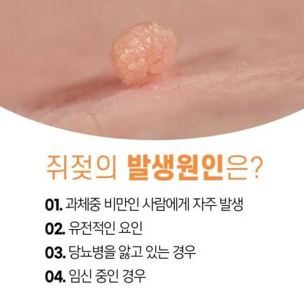 발생 원인