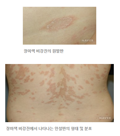 장미색 비강진