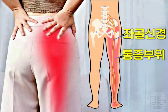 좌골신경통 예방 습관 운동 수면자세