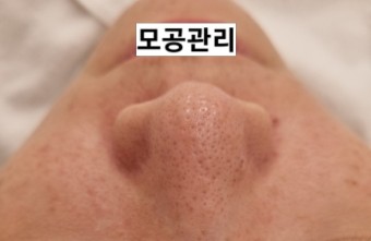 모공 관리