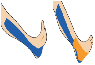 발목 내측 염좌