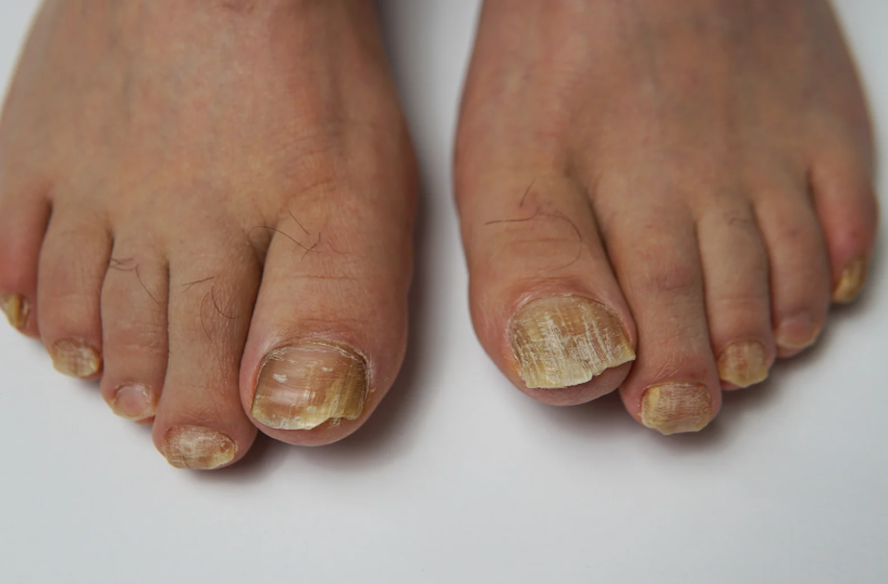 발톱무좀 약 추천 및 치료약 분석