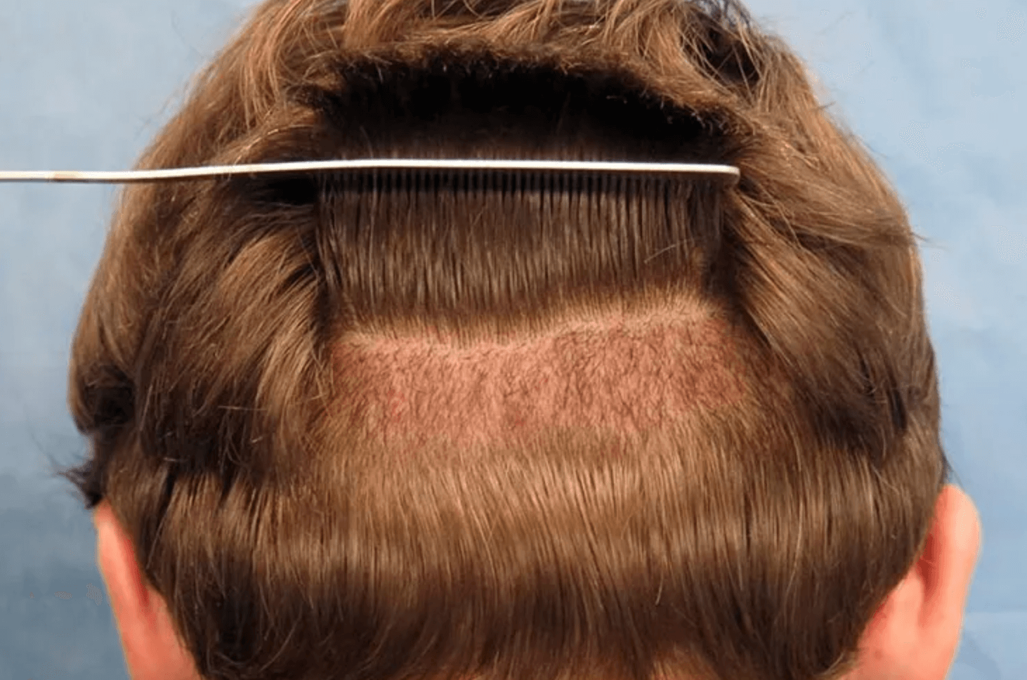 모발-이식-비용