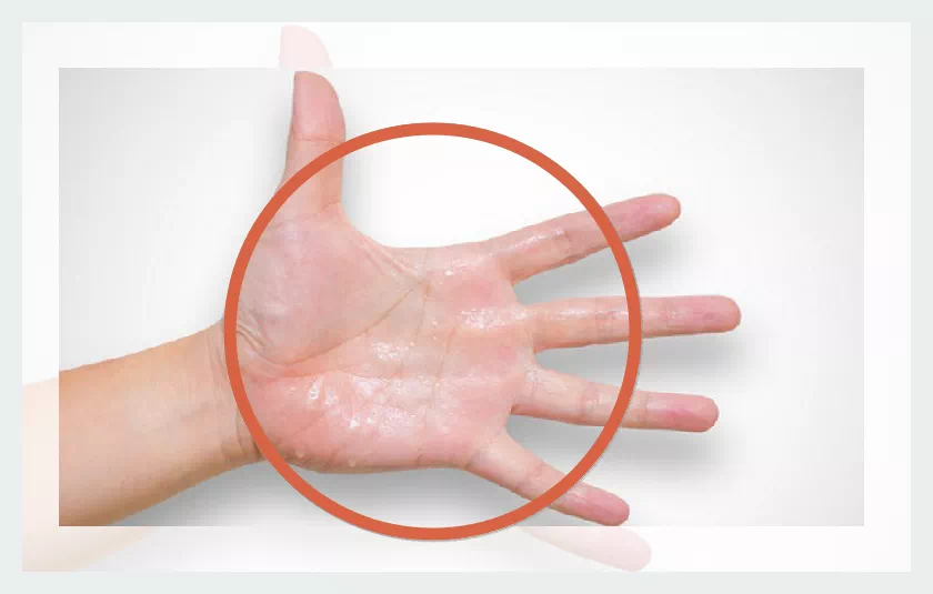 손바닥 다한증