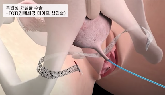 요실금 수술 애니메이션 사진