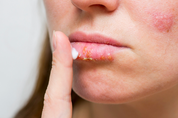 면역체계약화-구순포진