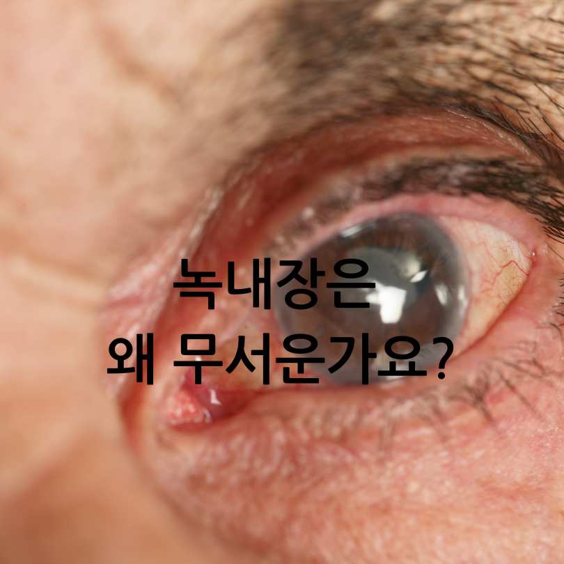 녹내장 진행을 멈춘 사람들의 관리방법