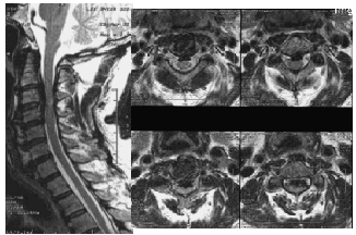 경추 후종 인대 골화증(Ossification of the Posterior Longitudinal Ligament of the Cervical Spine, OPLL)