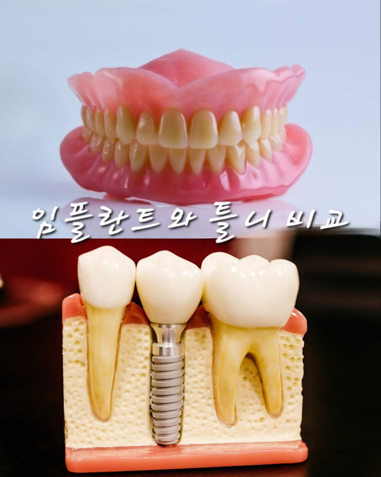 임플란트와 틀니 사진