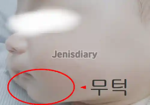 무턱 이미지