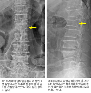 척추골절