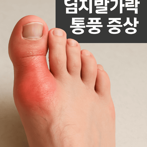 엄지 발가락 통풍 증상-썸네일이미지