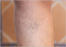 하지정맥류 증상 이미지