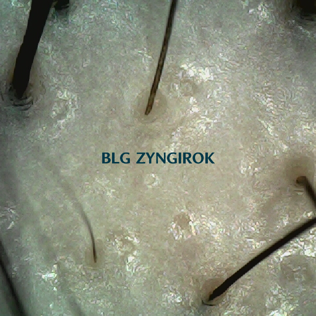 피나모아 복용 25주차 정수리와 이마 사이 부분 두피 사진 모습이다.