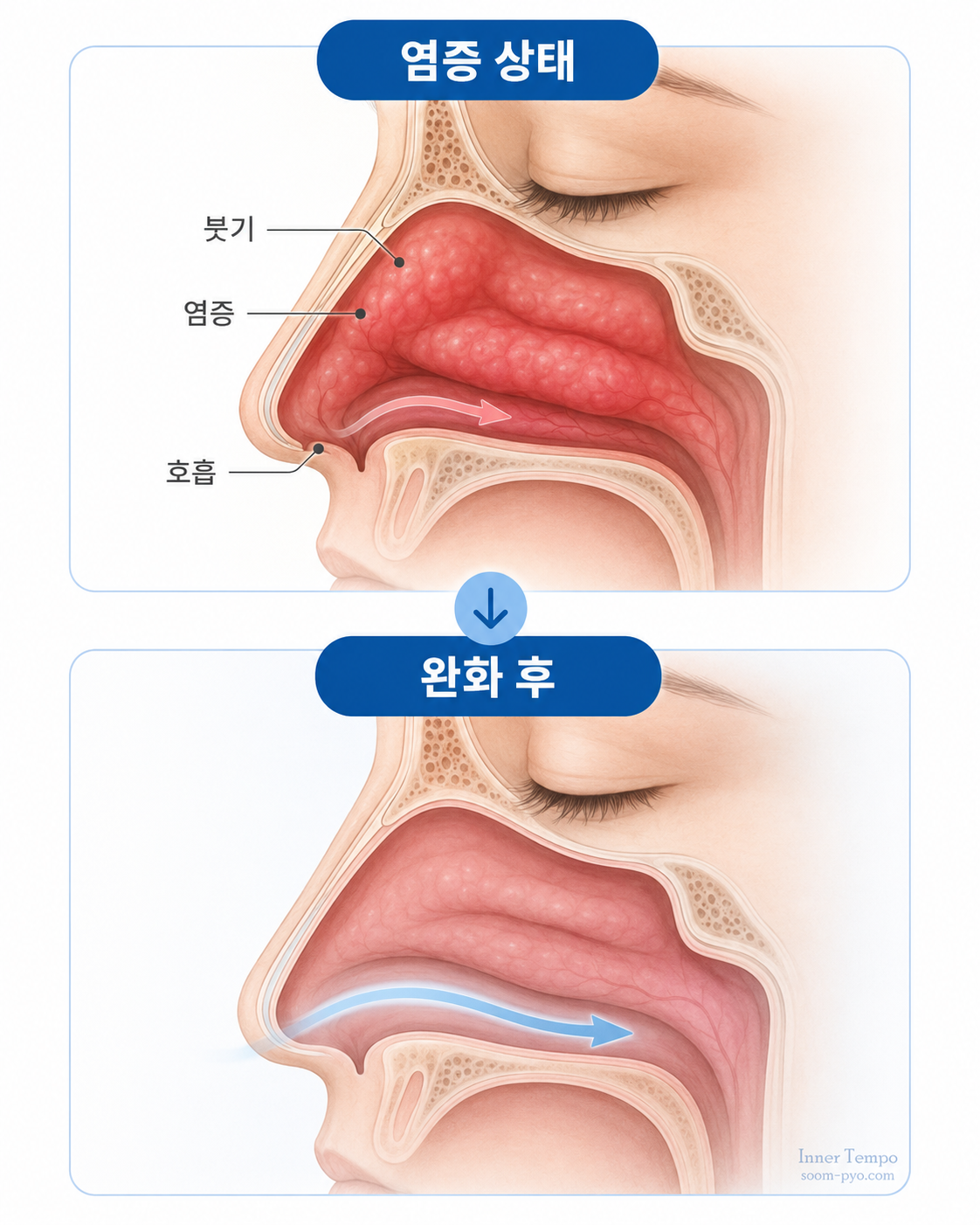 비염 치료 전후 비교