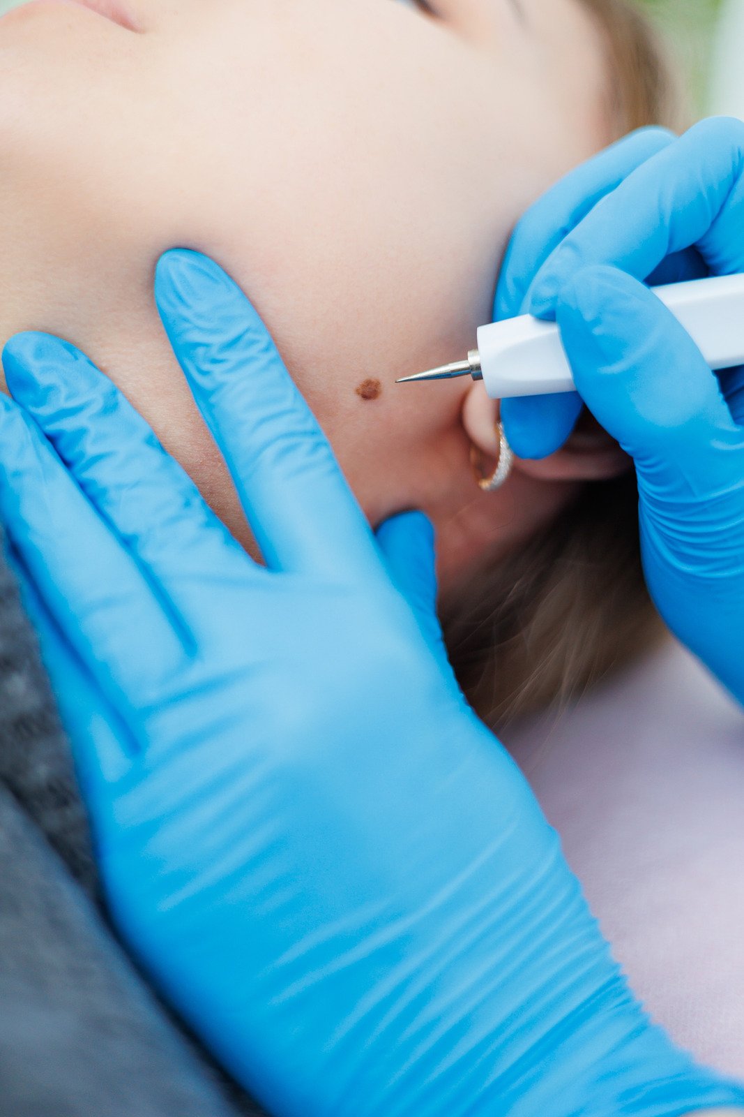 전기 소작기 치료