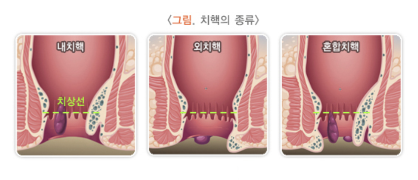 치핵의 종류