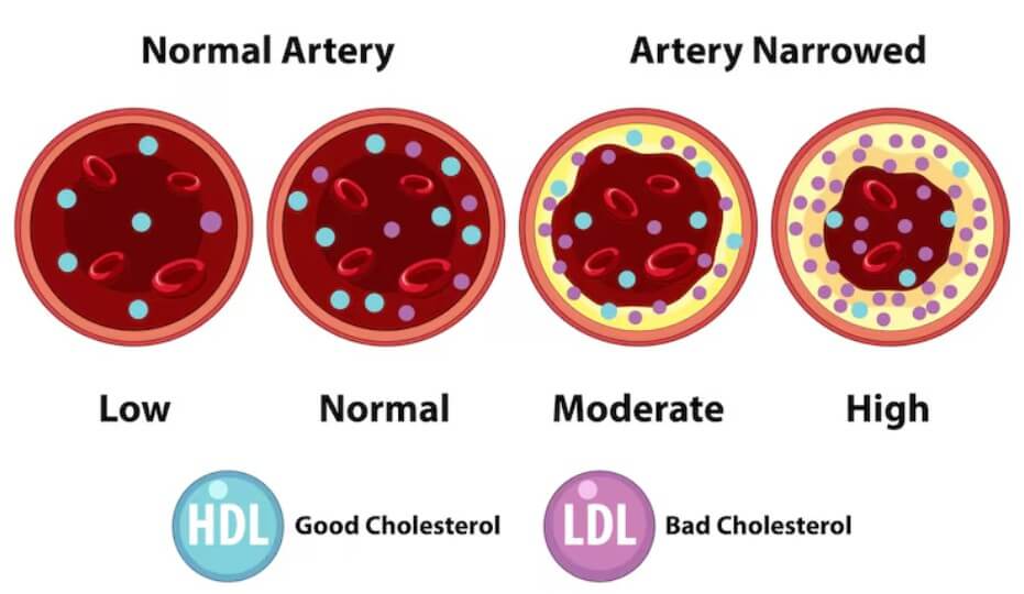 혈관 속 혈액 찌꺼기 양을 보여주는 모습