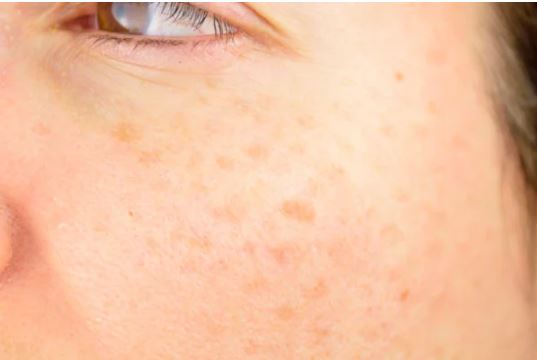 멜라논크림-효과