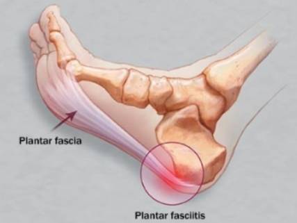 족저근막의 위치와 족저근막염이 생길 시 통증부위