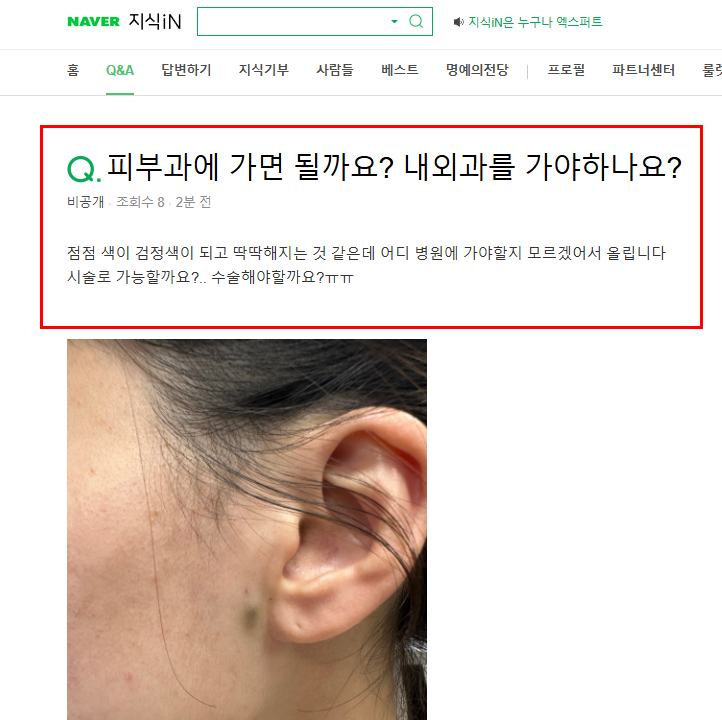 귀 밑 피지낭종 질문