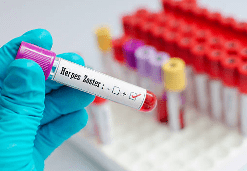 대상포진 예방접종 가격