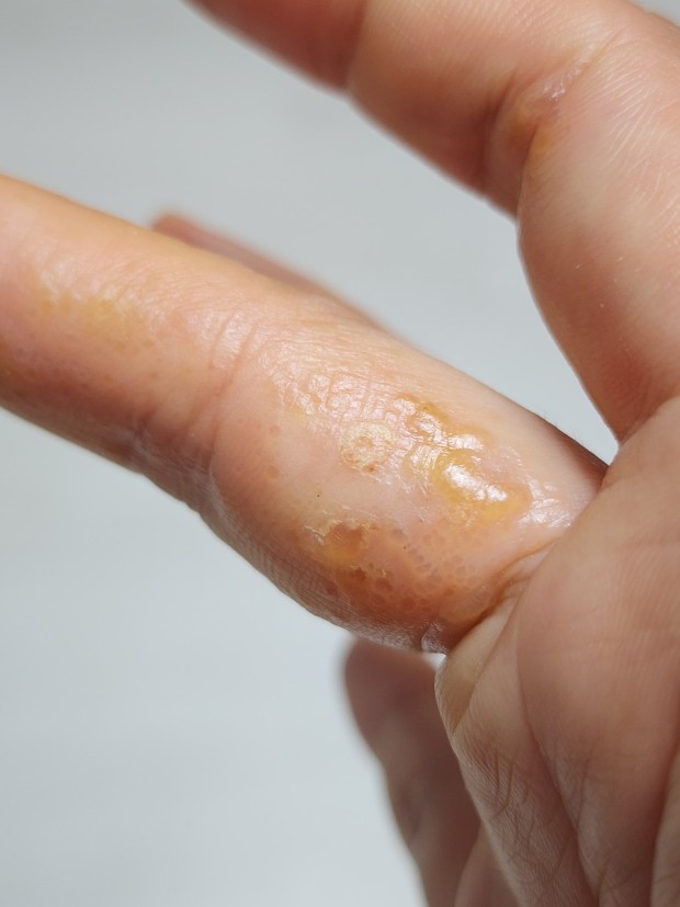 손바닥-물집(한포진)