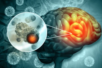 뇌종양 초기증상