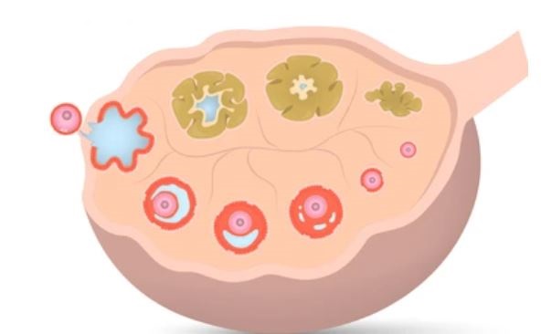 다낭성 난소 증후군 치료방법