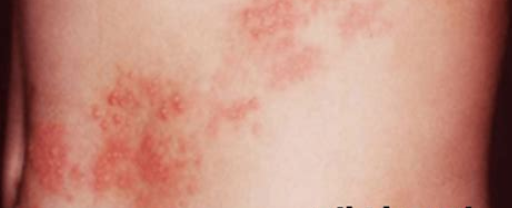 대상포진 초기증상 2