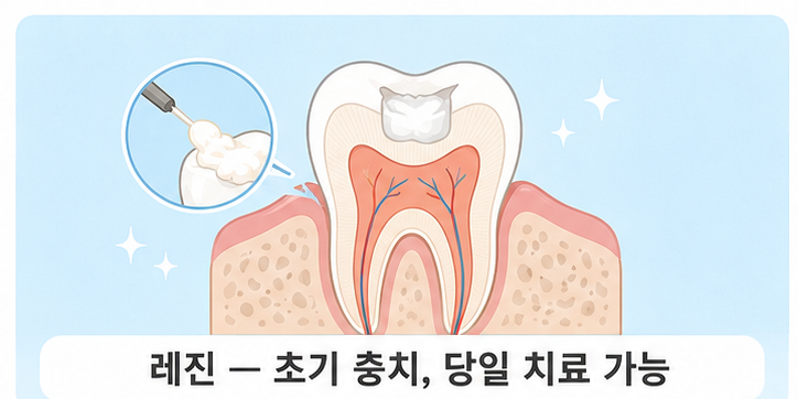레진 &mdash; 가장 간단한 직접 충전